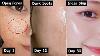 Damaged Skin Repair In 30 Days Close Large Open Pores U0026 Remove Dark Spots Get Glass Skin
